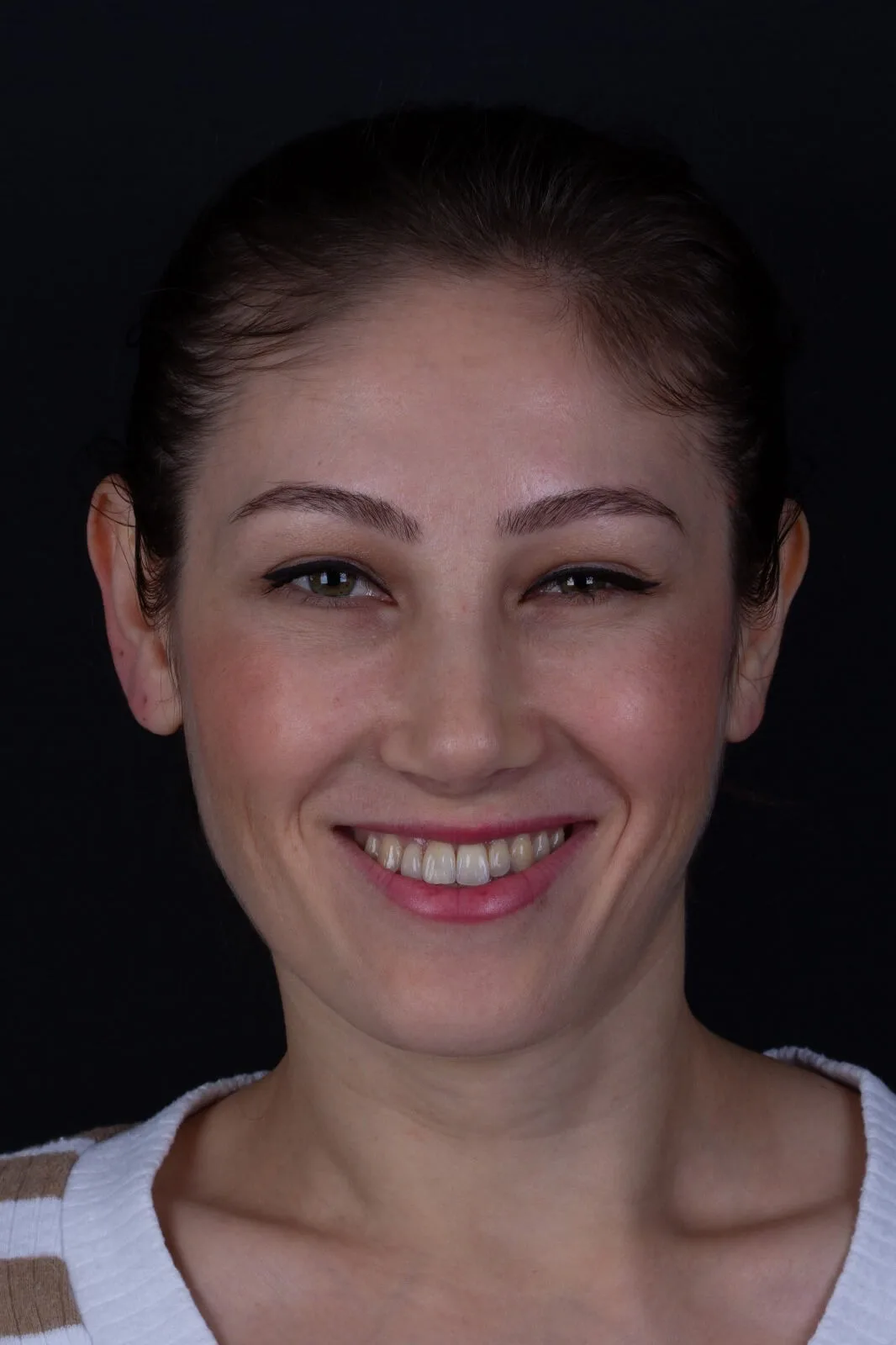 Cephe: Dişler okluzyonda gülerken